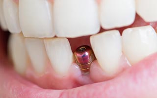 Einzelzahnimplantat Berlin