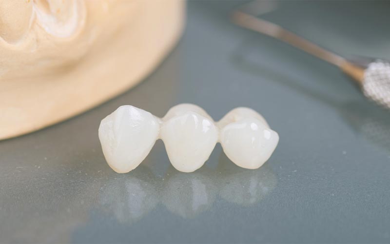 Festsitzender Zahnersatz