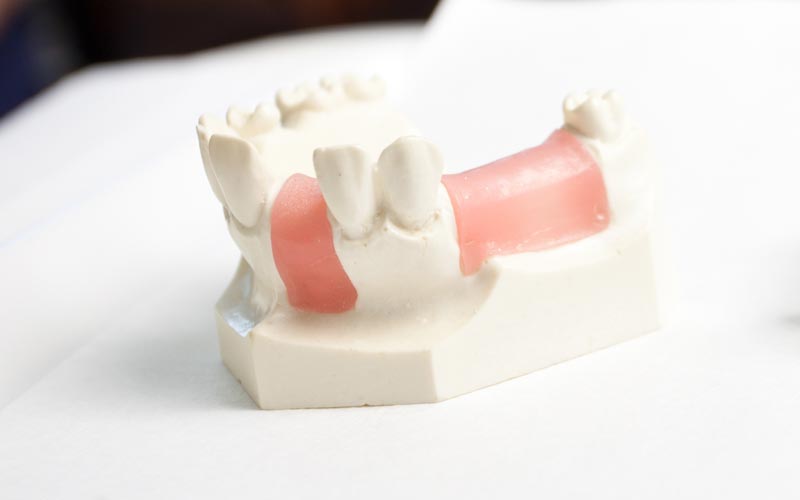 Freiendsituation für mehrer fehlende Zähne