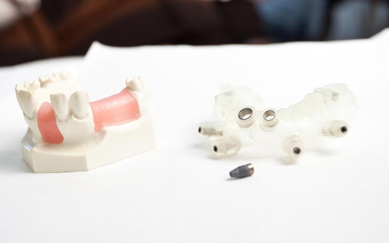 Implantat für mehrere fehlende Zähne