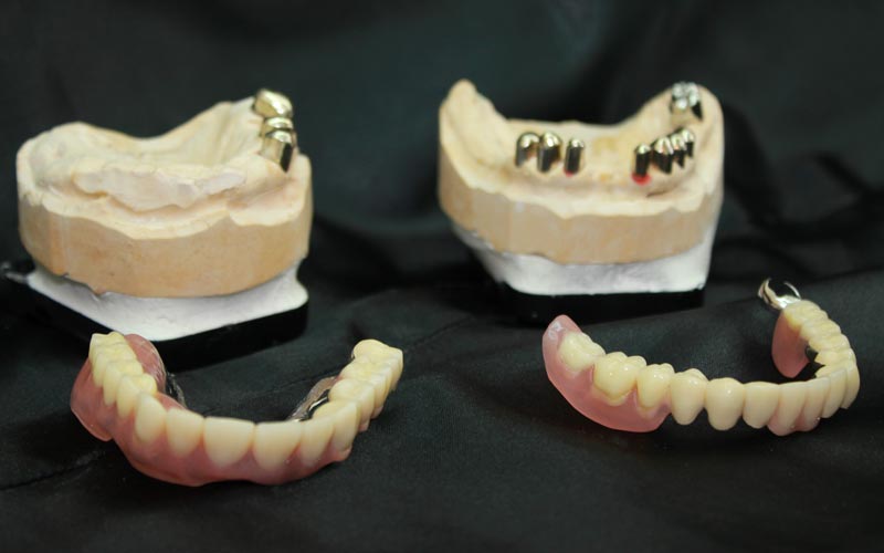 Möglichkeit für Zahnersatz