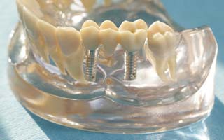 Knochenaufbau vor der Implantatbehandlung