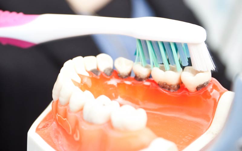 Schutz vor ansteckender Parodontose