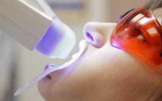 Vorteil von professionellem Bleaching