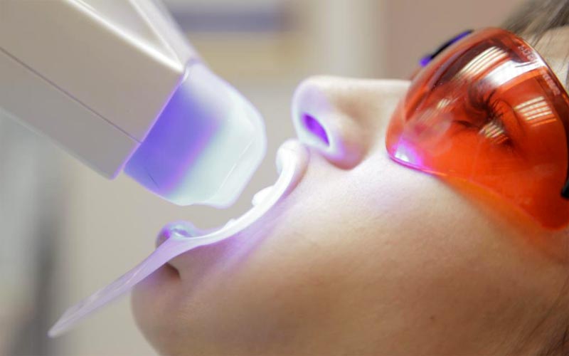 Vorteile von professionellem Bleaching