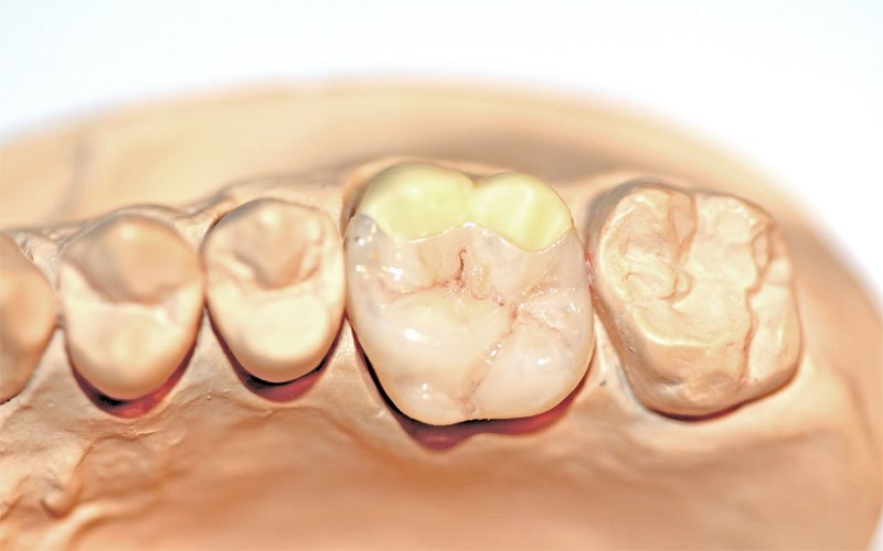 Inlay oder Einlagefüllung