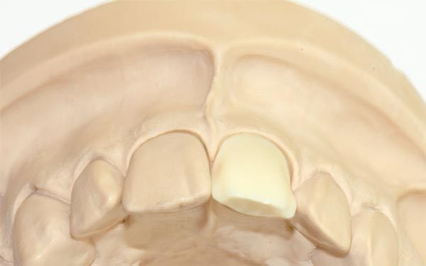 Veneers Vorbereitung