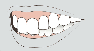 Grafik einer Zahnfehlstellung