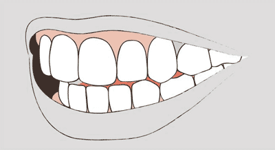 Grafik einer Zahnfehlstellung