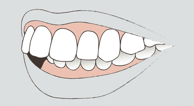 Grafik einer Zahnfehlstellung