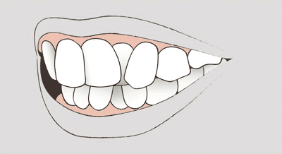 Grafik einer Zahnfehlstellung