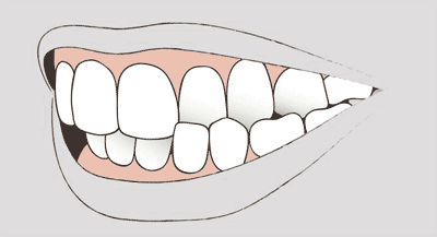 Grafik einer Zahnfehlstellung
