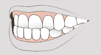 Grafik einer Zahnfehlstellung