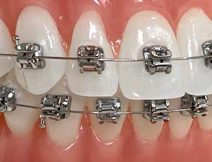 Multiband-Apparatur zur Korrektur des Kiefers