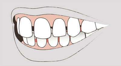 Abbildung einer Zahnfehlstellung