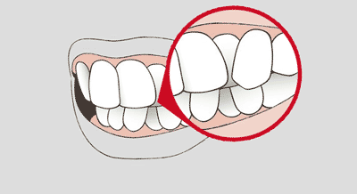 Grafik einer Zahnfehlstellung