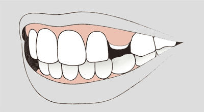 Grafik eines Milchzahnes