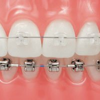 Detailaufnahme von Brackets an einer Zahnspange