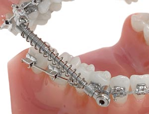 Anwendungsbeispiel einer Forsus Feder