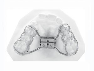 Beispiel einer Gaumennahterweiterungsapparatur