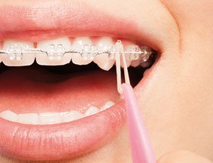 Frau bringt Zahnspangengummis an