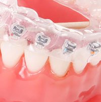 Abbildung einer unsichtbaren Zahnspange auf den Zähnen