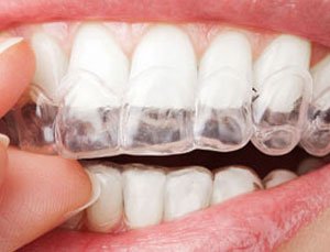 Invisalign vor Gebiss