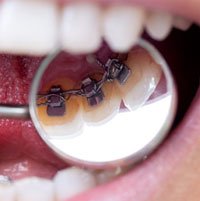 Unsichtbare feste Zahnspange