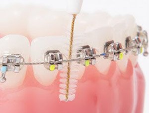 Professionelle Zahnreinigung mit fester Zahnspange