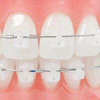 Detailaufnahme von Brackets an einer Zahnspange