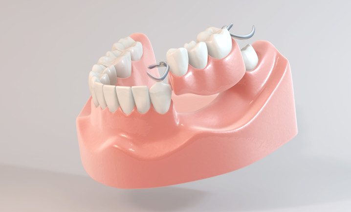 Modell eines Kiefers mit einer Teilprothese