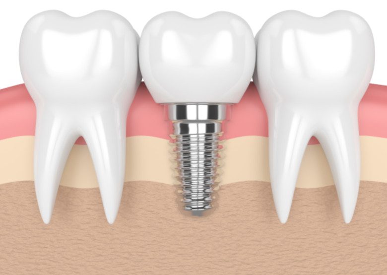 Grafik eines Kiefers mit einem Implantat