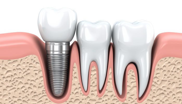 Zahnimplantat Modell